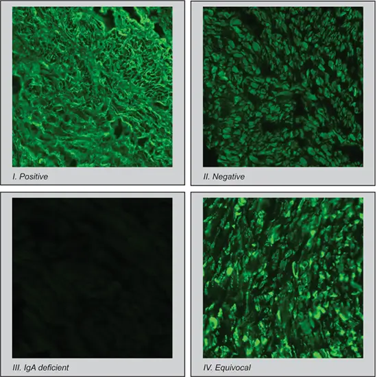 Anti-Reticulin IgA Antibodies Test